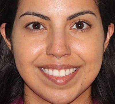 Lip Augmentation Before & After Gallery - Patient 12736009 - Image 1