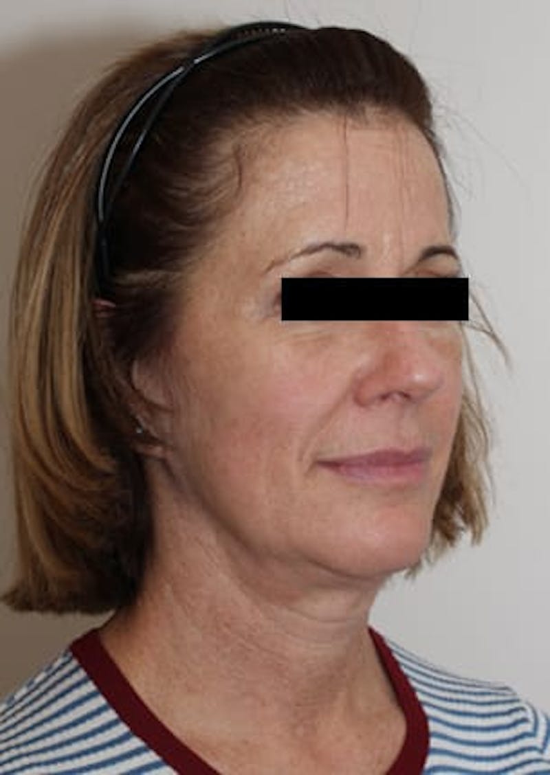 Facelift/Necklift Before & After Gallery - Patient 12736005 - Image 3