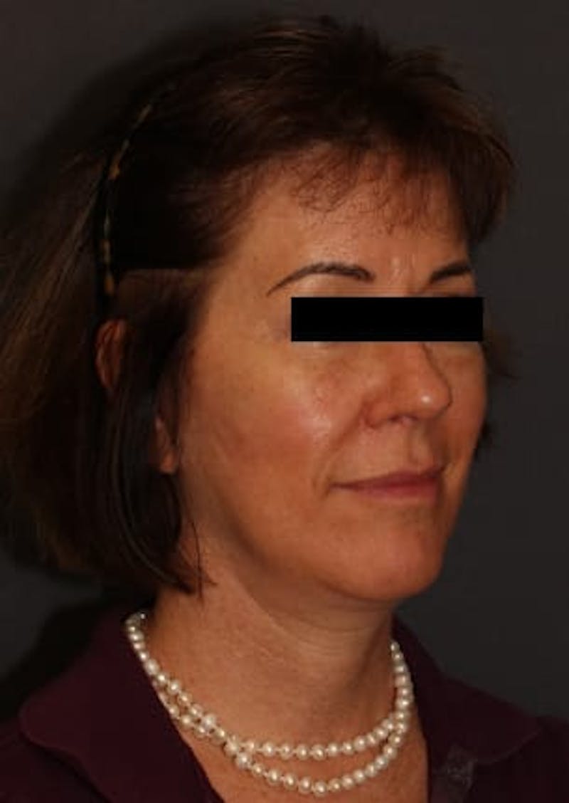 Facelift/Necklift Before & After Gallery - Patient 12736005 - Image 4
