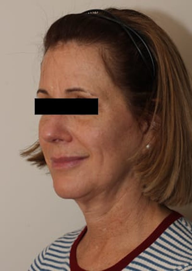 Facelift/Necklift Before & After Gallery - Patient 12736005 - Image 5