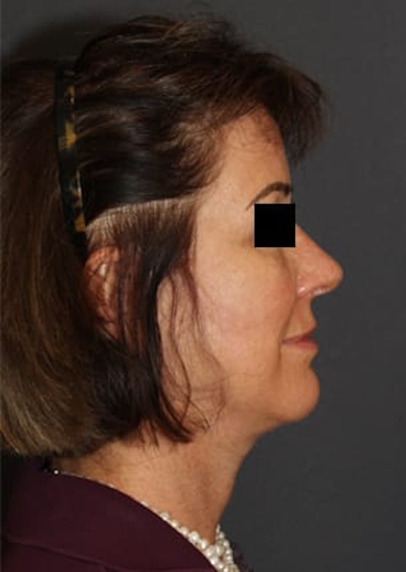 Facelift/Necklift Before & After Gallery - Patient 12736005 - Image 8