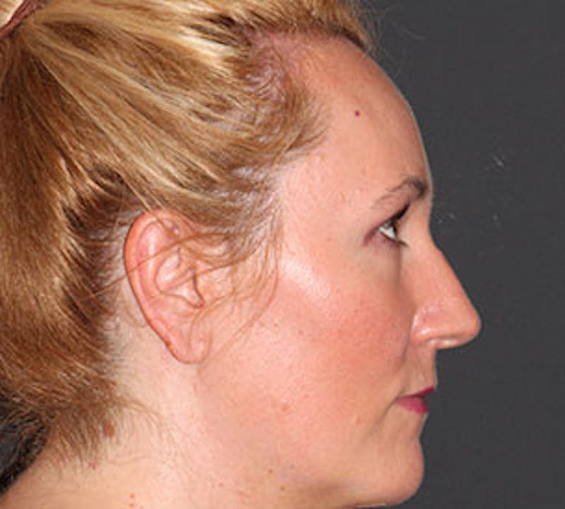 Blepharoplasty Before & After Gallery - Patient 12736006 - Image 8