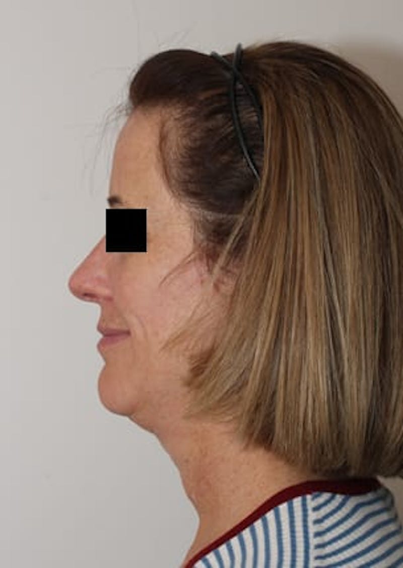 Facelift/Necklift Before & After Gallery - Patient 12736005 - Image 9