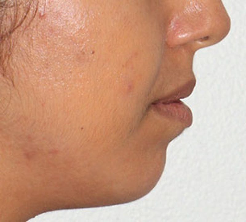 Lip Augmentation Before & After Gallery - Patient 12736009 - Image 9