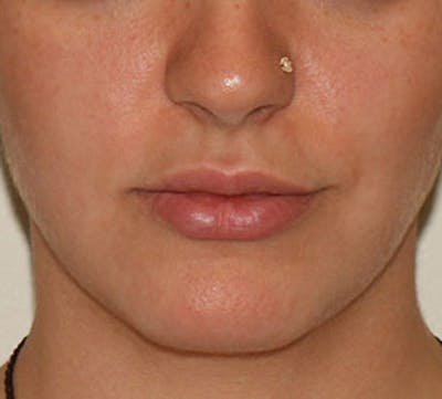 Lip Augmentation Before & After Gallery - Patient 12736019 - Image 1