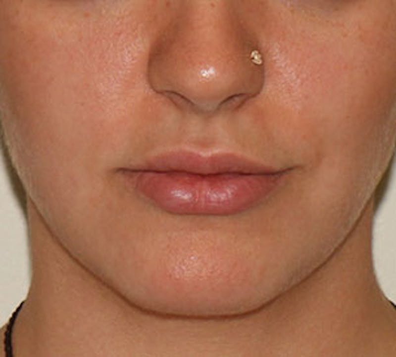 Lip Augmentation Before & After Gallery - Patient 12736019 - Image 1