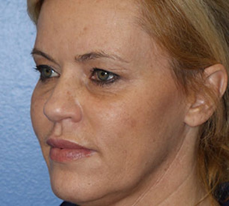 Blepharoplasty Before & After Gallery - Patient 12736014 - Image 5