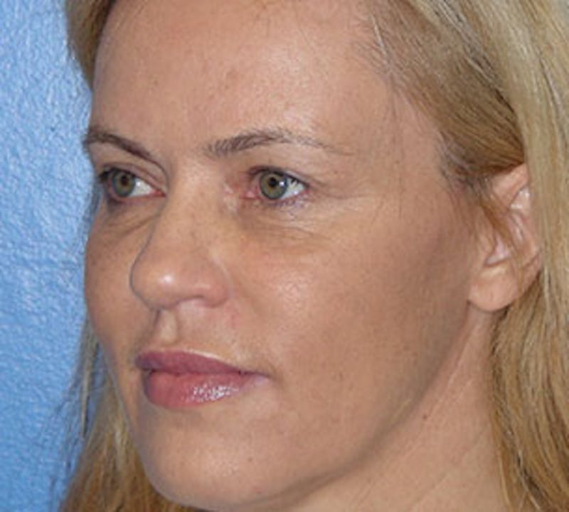 Blepharoplasty Before & After Gallery - Patient 12736014 - Image 6