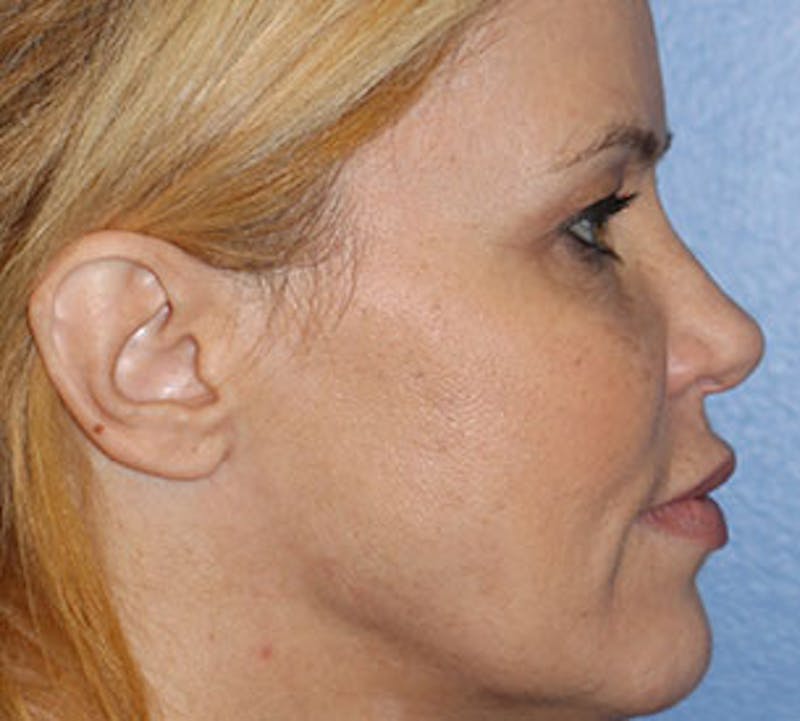 Blepharoplasty Before & After Gallery - Patient 12736014 - Image 7