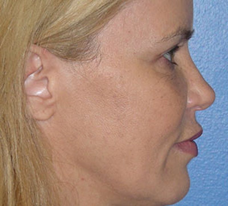 Blepharoplasty Before & After Gallery - Patient 12736014 - Image 8