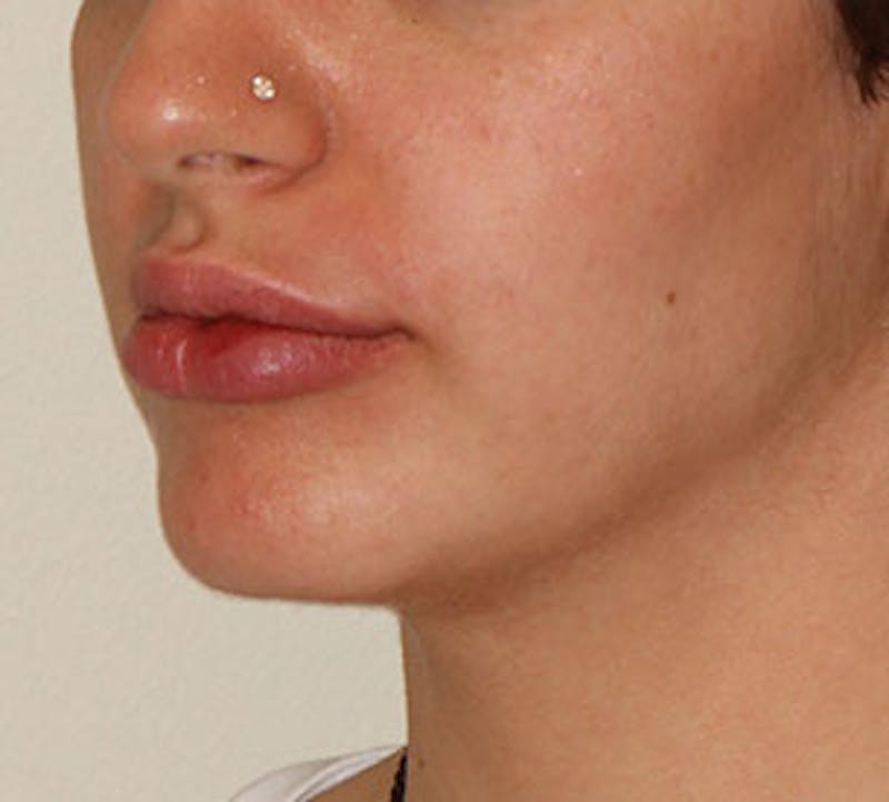 Lip Augmentation Before & After Gallery - Patient 12736019 - Image 8