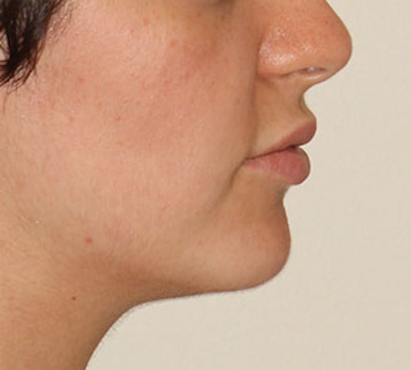 Lip Augmentation Before & After Gallery - Patient 12736019 - Image 9
