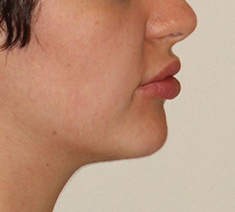 Lip Augmentation Before & After Gallery - Patient 12736019 - Image 10