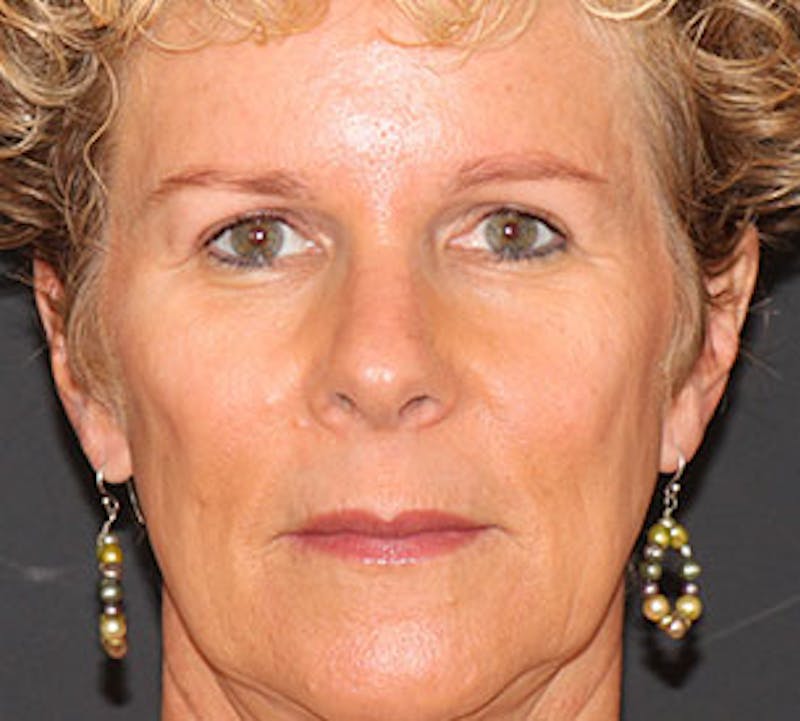 Blepharoplasty Before & After Gallery - Patient 12736023 - Image 2