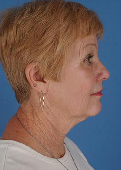 Facelift/Necklift Before & After Gallery - Patient 12736022 - Image 1