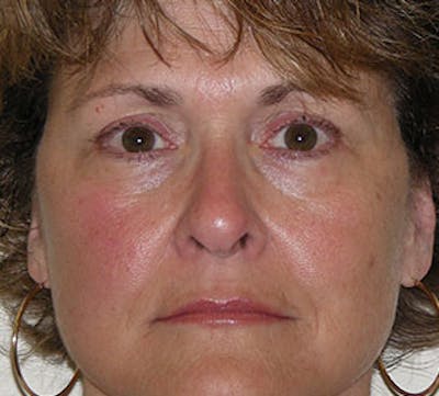 Lip Augmentation Before & After Gallery - Patient 12736027 - Image 2