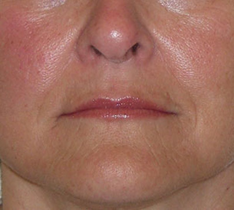 Lip Augmentation Before & After Gallery - Patient 12736027 - Image 4