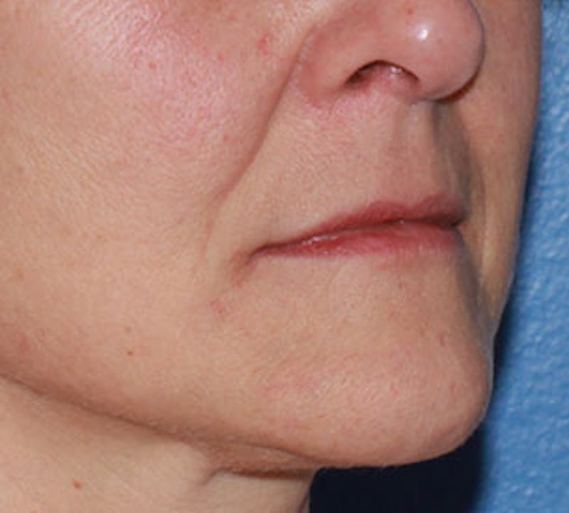Lip Augmentation Before & After Gallery - Patient 12736027 - Image 5