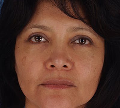 Blepharoplasty Before & After Gallery - Patient 12736028 - Image 2
