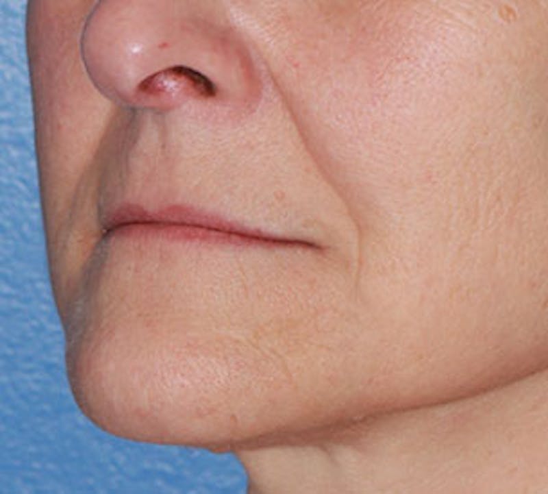 Lip Augmentation Before & After Gallery - Patient 12736027 - Image 7