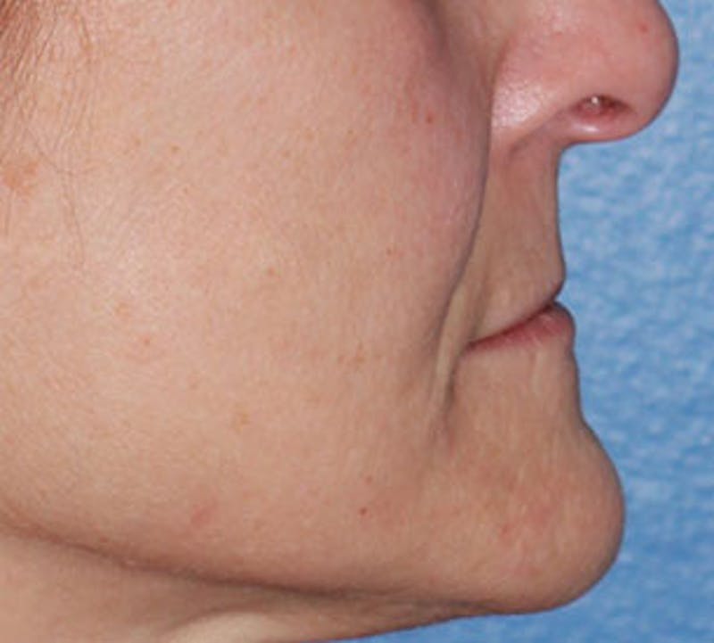 Lip Augmentation Before & After Gallery - Patient 12736027 - Image 9