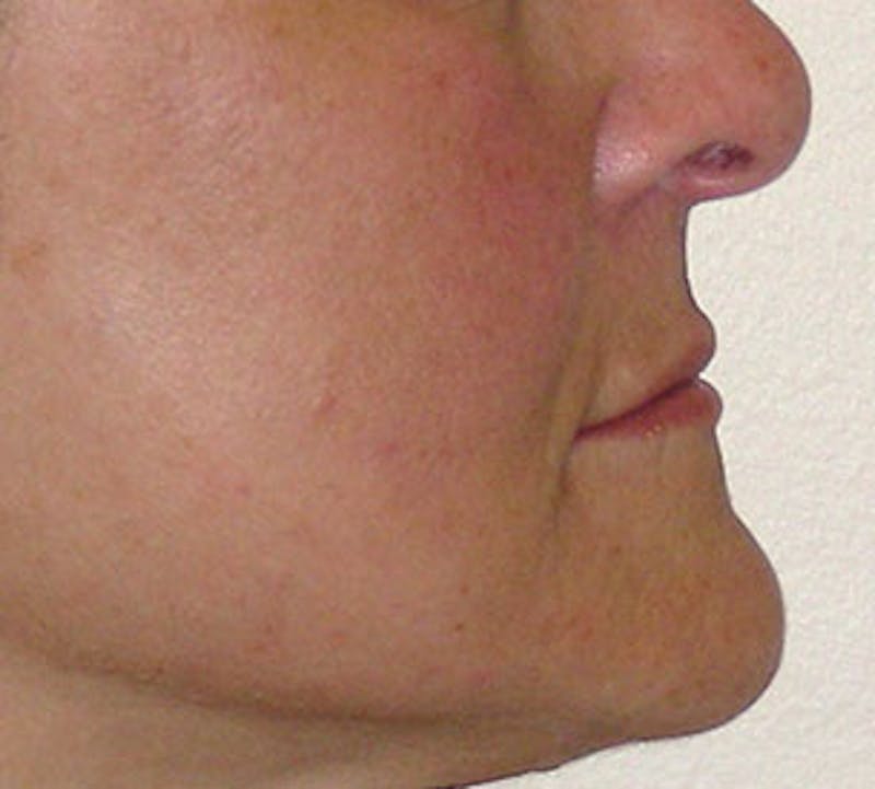 Lip Augmentation Before & After Gallery - Patient 12736027 - Image 10