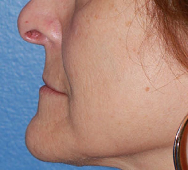 Lip Augmentation Before & After Gallery - Patient 12736027 - Image 11