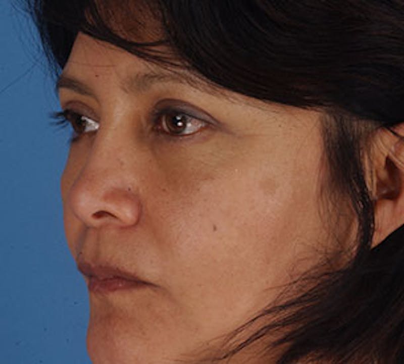 Blepharoplasty Before & After Gallery - Patient 12736028 - Image 8