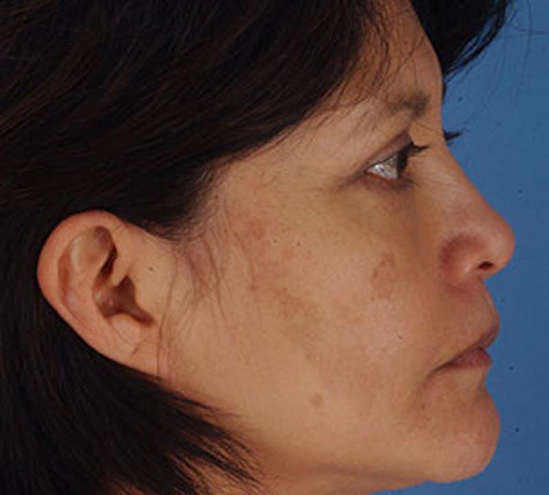 Blepharoplasty Before & After Gallery - Patient 12736028 - Image 10