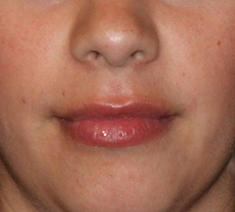 Lip Augmentation Before & After Gallery - Patient 12736030 - Image 3