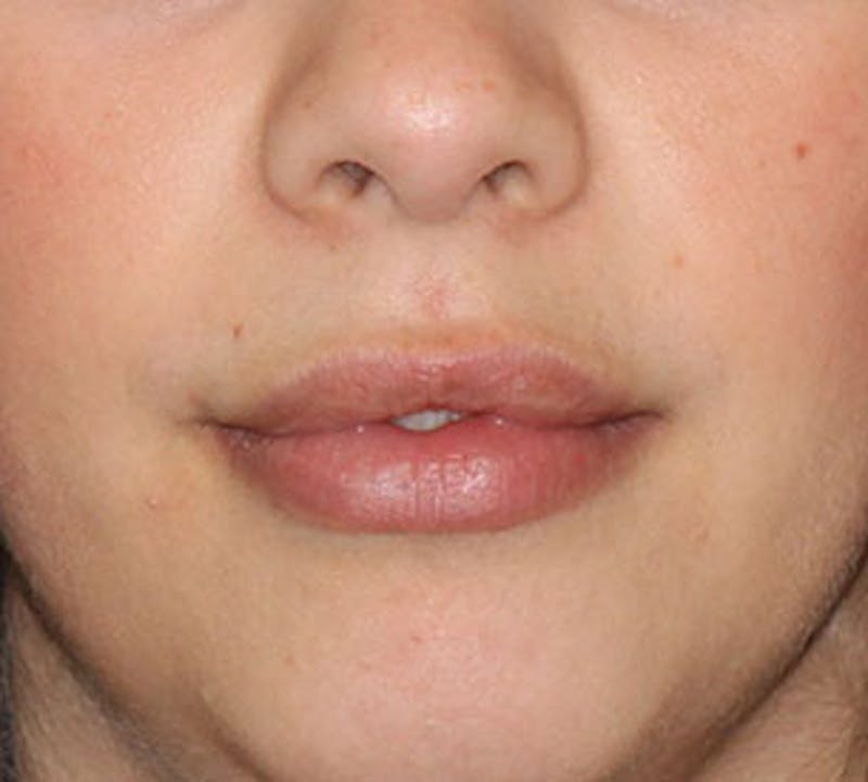 Lip Augmentation Before & After Gallery - Patient 12736030 - Image 4