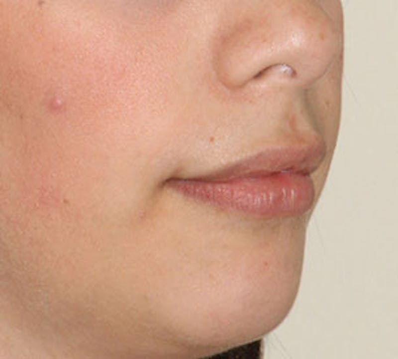 Lip Augmentation Before & After Gallery - Patient 12736030 - Image 6
