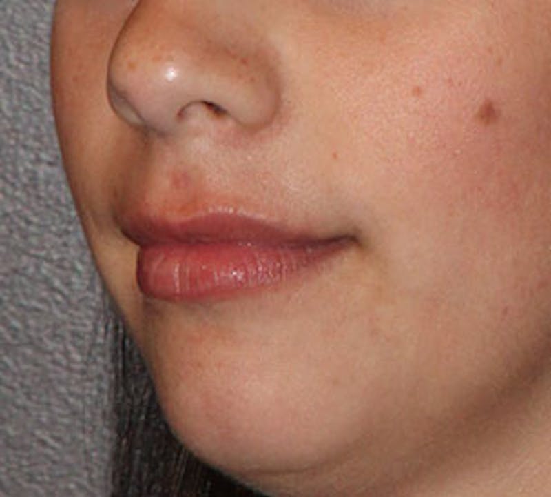 Lip Augmentation Before & After Gallery - Patient 12736030 - Image 7