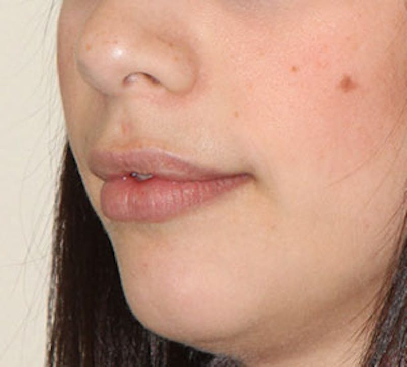 Lip Augmentation Before & After Gallery - Patient 12736030 - Image 8