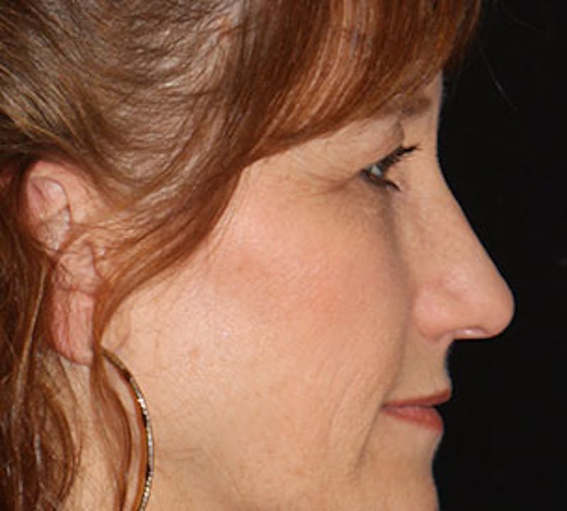 Blepharoplasty Before & After Gallery - Patient 12736035 - Image 7