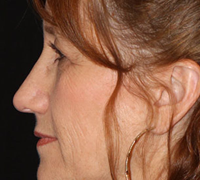 Blepharoplasty Before & After Gallery - Patient 12736035 - Image 9
