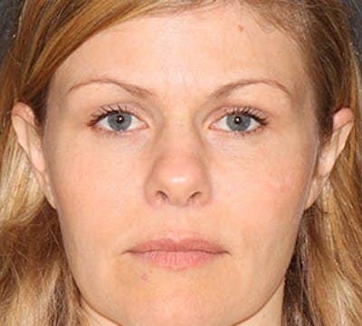 Blepharoplasty Before & After Gallery - Patient 12736036 - Image 2