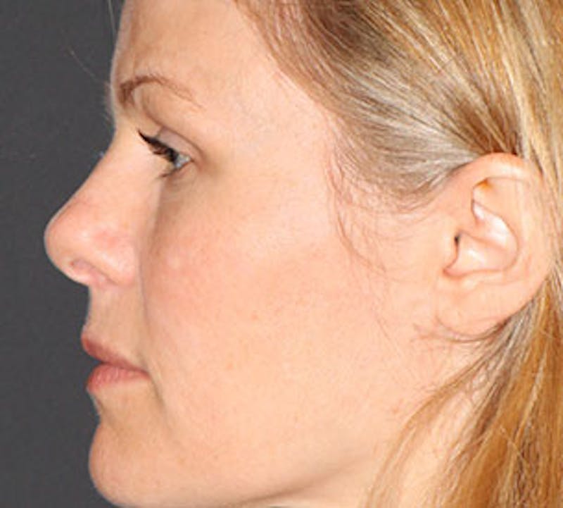 Blepharoplasty Before & After Gallery - Patient 12736036 - Image 10