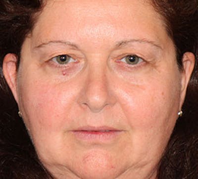 Blepharoplasty Before & After Gallery - Patient 12736037 - Image 1