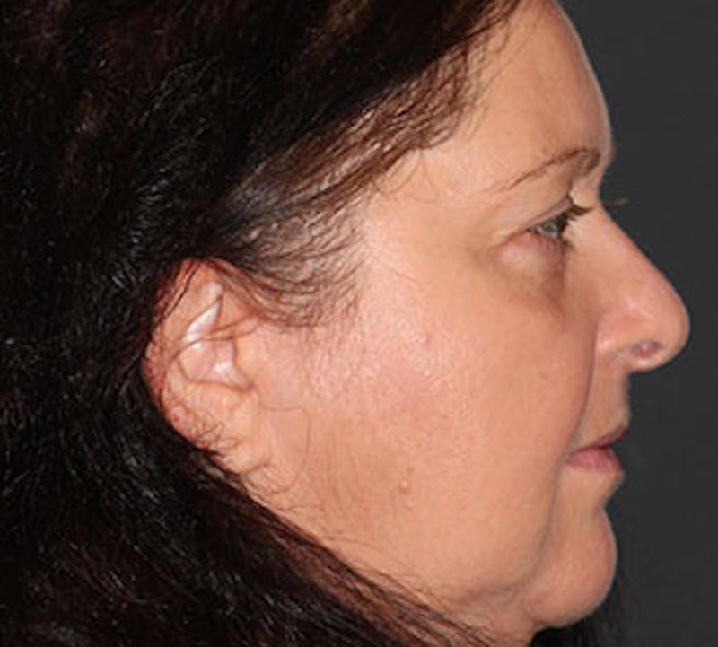 Blepharoplasty Before & After Gallery - Patient 12736037 - Image 8