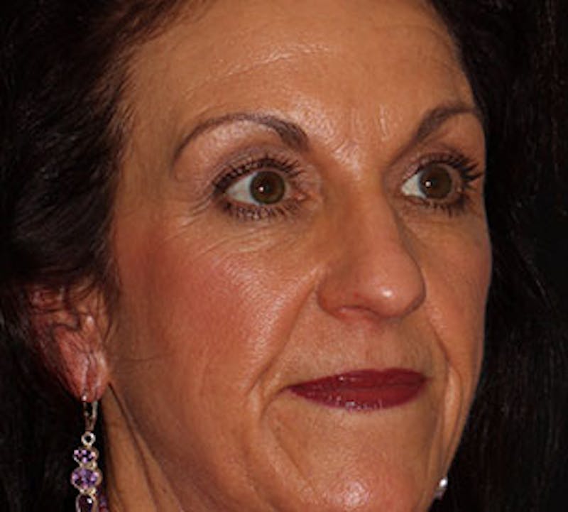 Blepharoplasty Before & After Gallery - Patient 12737051 - Image 3