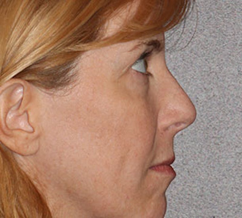 Blepharoplasty Before & After Gallery - Patient 12737053 - Image 7