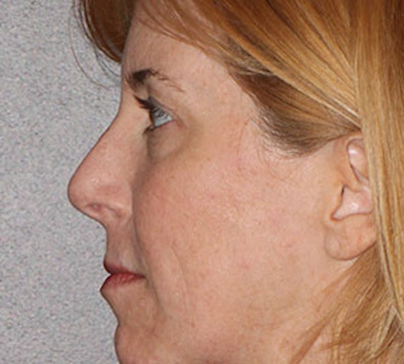 Blepharoplasty Before & After Gallery - Patient 12737053 - Image 9