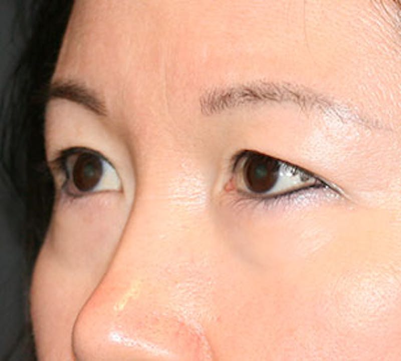 Blepharoplasty Before & After Gallery - Patient 12737122 - Image 5