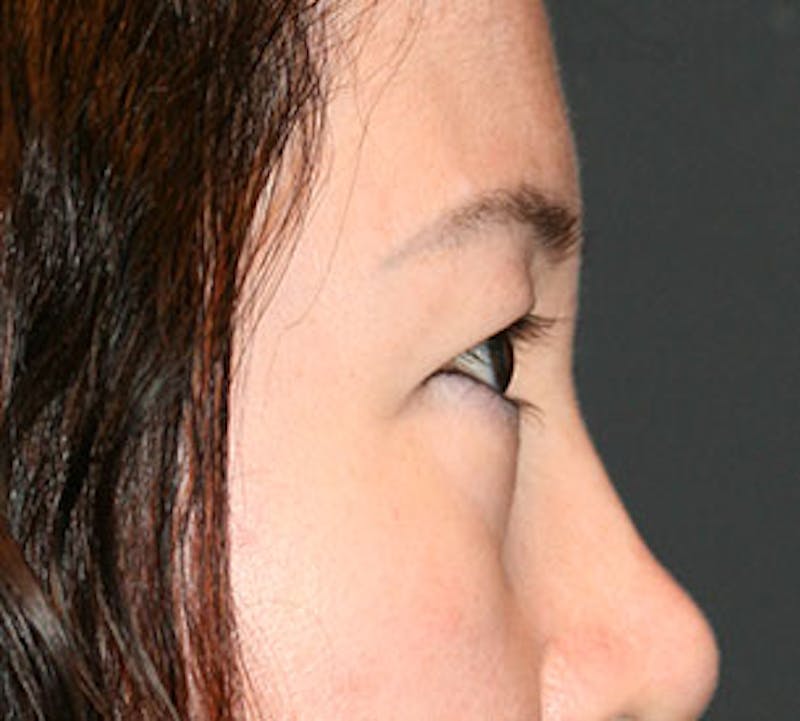 Blepharoplasty Before & After Gallery - Patient 12737122 - Image 7