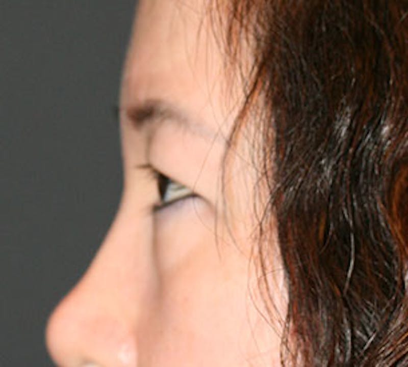 Blepharoplasty Before & After Gallery - Patient 12737122 - Image 9