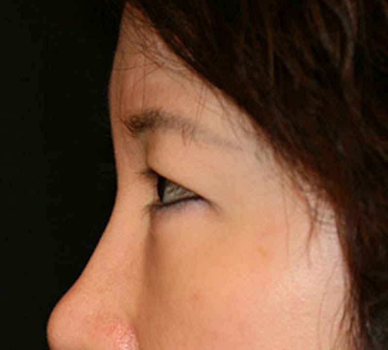 Blepharoplasty Before & After Gallery - Patient 12737122 - Image 10