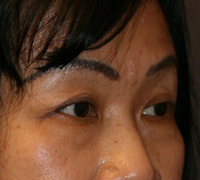 Blepharoplasty Before & After Gallery - Patient 12737123 - Image 3