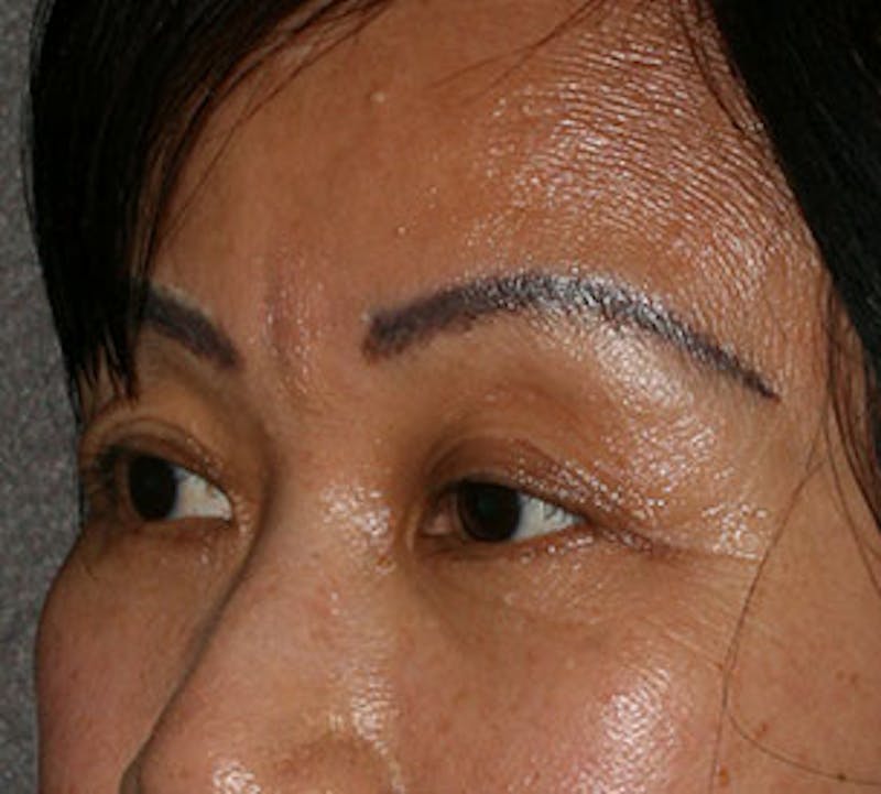 Blepharoplasty Before & After Gallery - Patient 12737123 - Image 6