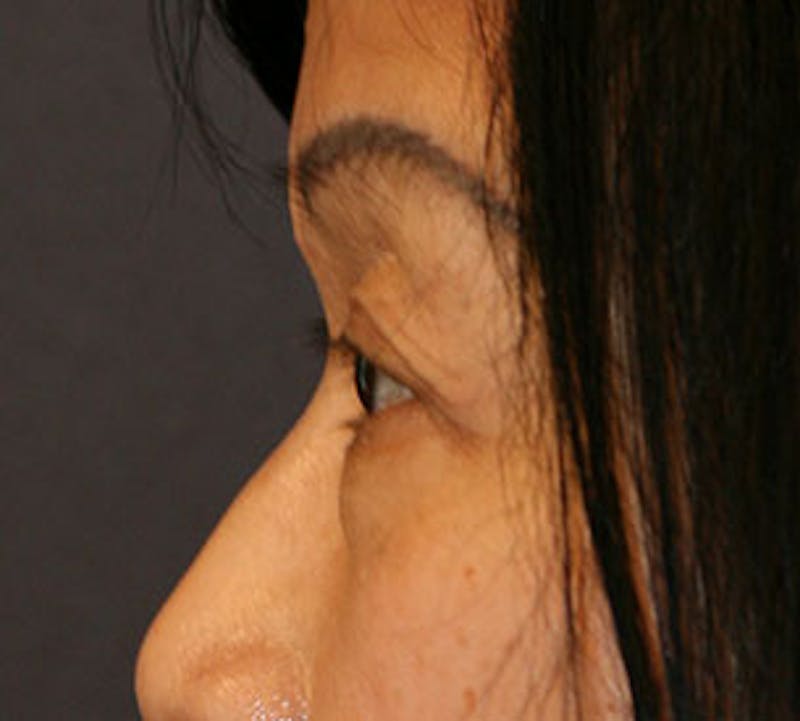 Blepharoplasty Before & After Gallery - Patient 12737123 - Image 7